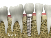 dental_implant_diagram_large