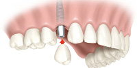 dental_implant_supported_crown