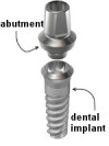 implant_abutment